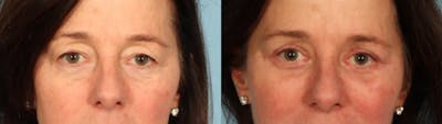 Eyelid Surgery Before & After Gallery - Patient 702467 - Image 1