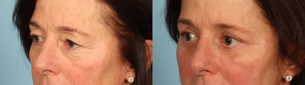 Eyelid Surgery Before & After Gallery - Patient 702467 - Image 2