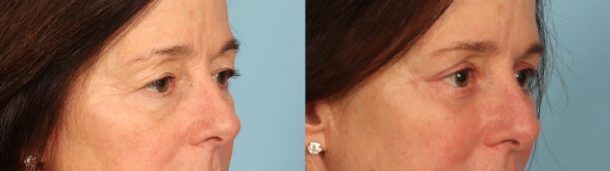 Eyelid Surgery Before & After Gallery - Patient 702467 - Image 3