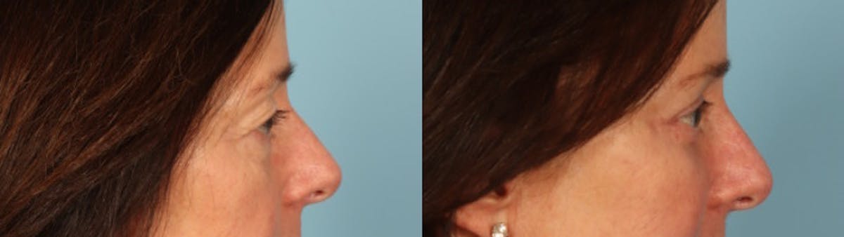 Eyelid Surgery Before & After Gallery - Patient 702467 - Image 5