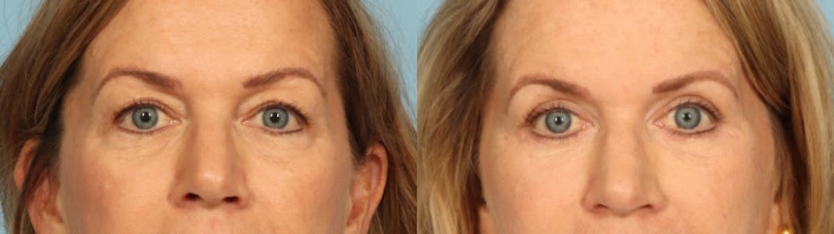Eyelid Surgery Before & After Gallery - Patient 424356 - Image 1