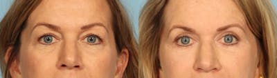 Eyelid Surgery Before & After Gallery - Patient 424356 - Image 1