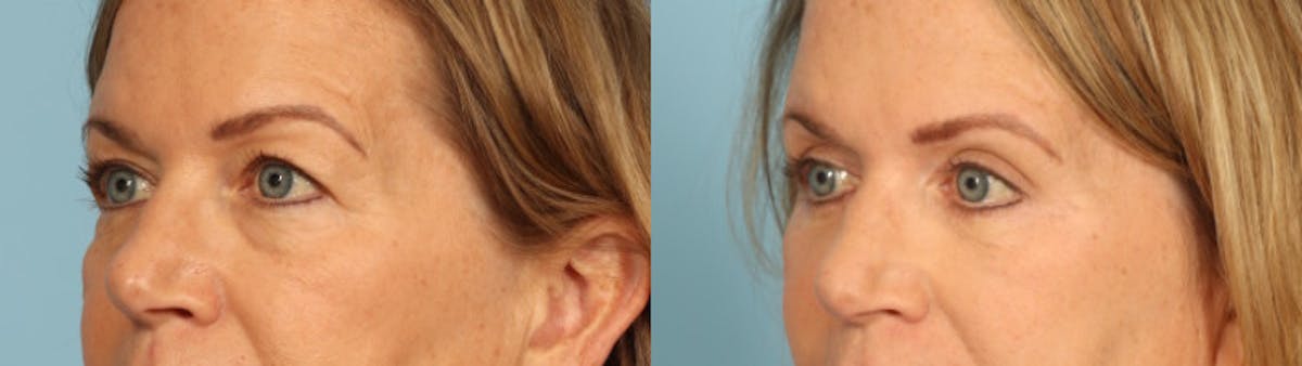 Eyelid Surgery Before & After Gallery - Patient 424356 - Image 2