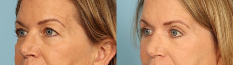 Eyelid Surgery Before & After Gallery - Patient 424356 - Image 2