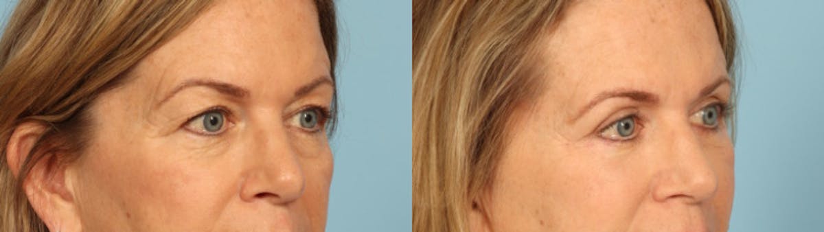 Eyelid Surgery Before & After Gallery - Patient 424356 - Image 3