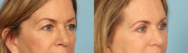 Eyelid Surgery Before & After Gallery - Patient 424356 - Image 3