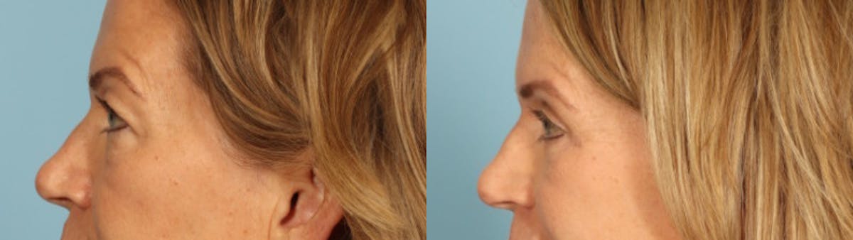 Eyelid Surgery Before & After Gallery - Patient 424356 - Image 4