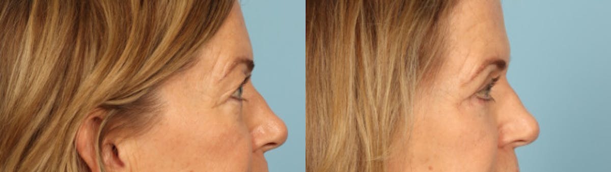 Eyelid Surgery Before & After Gallery - Patient 424356 - Image 5