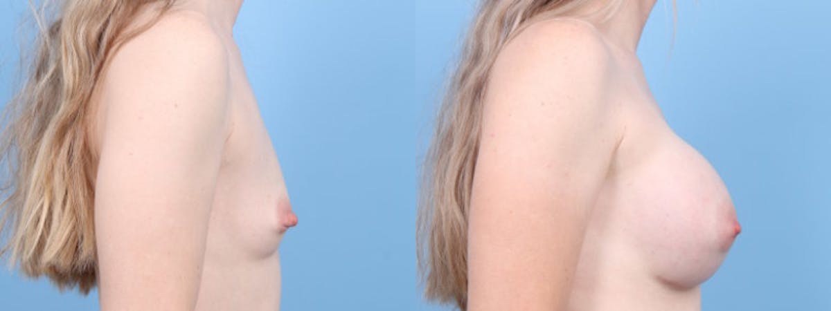 Breast Augmentation Before & After Gallery - Patient 408390 - Image 4