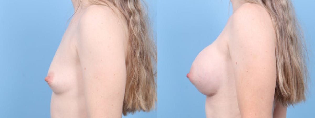 Breast Augmentation Before & After Gallery - Patient 408390 - Image 5