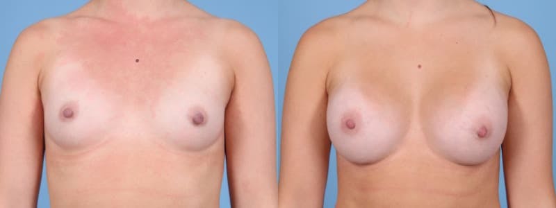 Breast Augmentation Before & After Gallery - Patient 147098 - Image 1