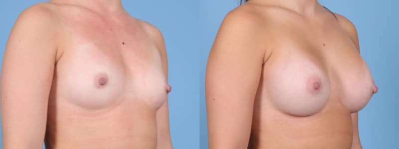 Breast Augmentation Before & After Gallery - Patient 147098 - Image 2