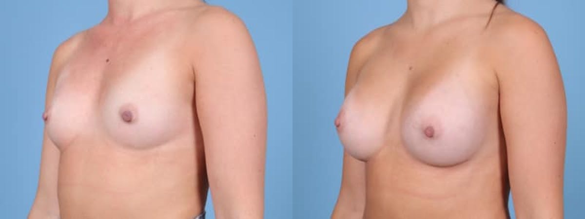 Breast Augmentation Before & After Gallery - Patient 147098 - Image 3