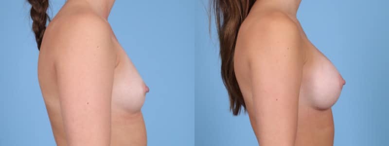 Breast Augmentation Before & After Gallery - Patient 147098 - Image 4