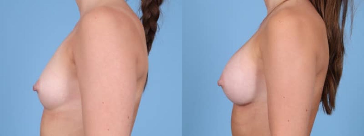 Breast Augmentation Before & After Gallery - Patient 147098 - Image 5