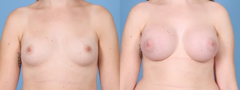 Breast Augmentation Before & After Gallery - Patient 395283 - Image 1