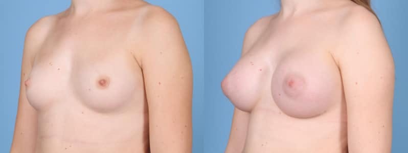 Breast Augmentation Before & After Gallery - Patient 395283 - Image 3