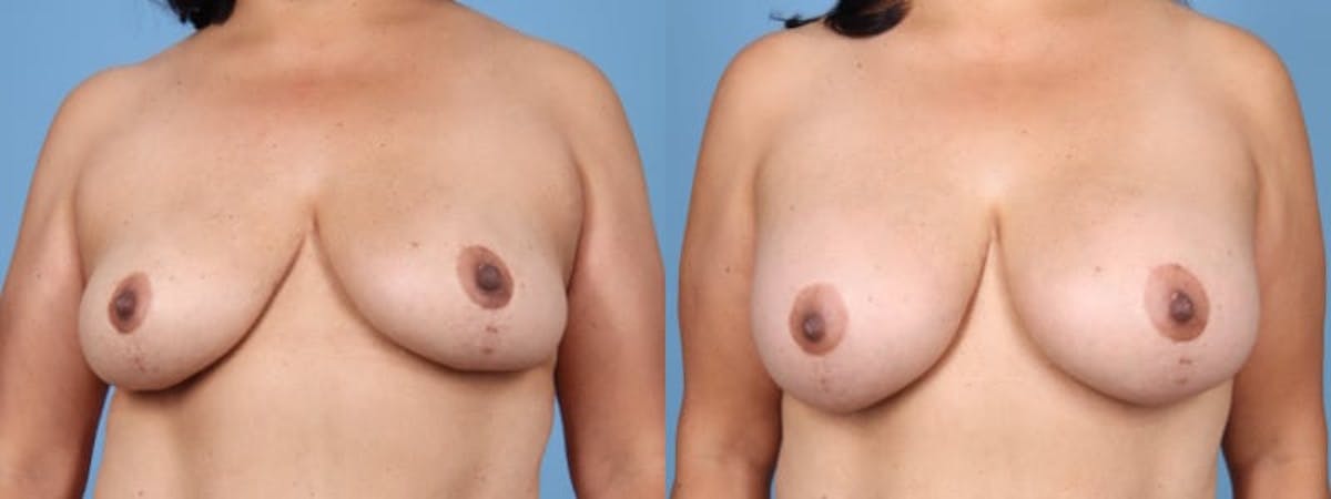 Breast Augmentation Before & After Gallery - Patient 155580 - Image 1