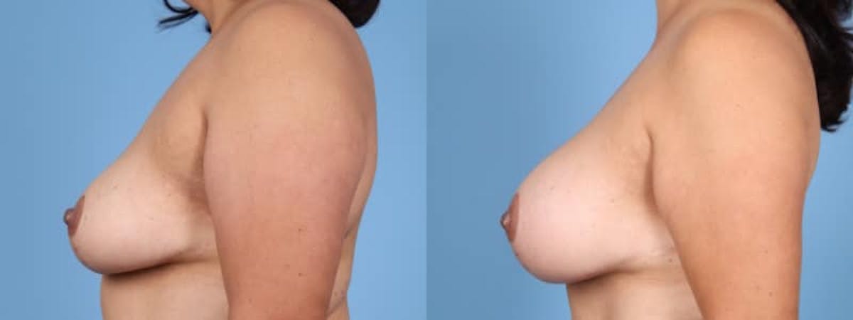 Breast Augmentation Before & After Gallery - Patient 155580 - Image 5