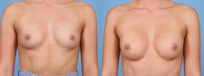 Breast Augmentation Before & After Gallery - Patient 273365 - Image 1