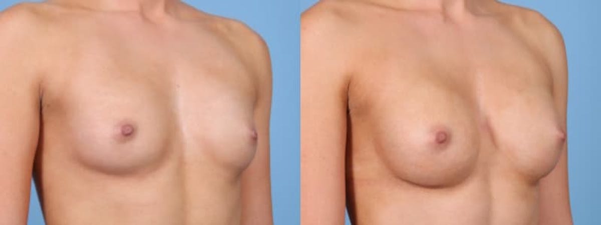 Breast Augmentation Before & After Gallery - Patient 273365 - Image 2