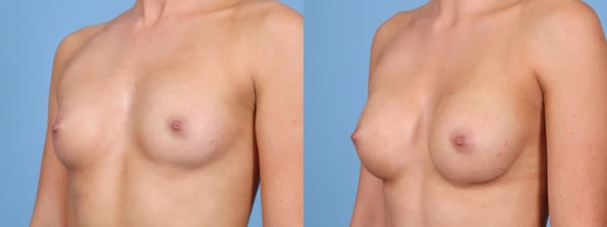 Breast Augmentation Before & After Gallery - Patient 273365 - Image 3