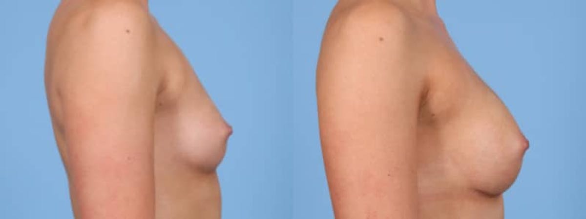 Breast Augmentation Before & After Gallery - Patient 273365 - Image 4