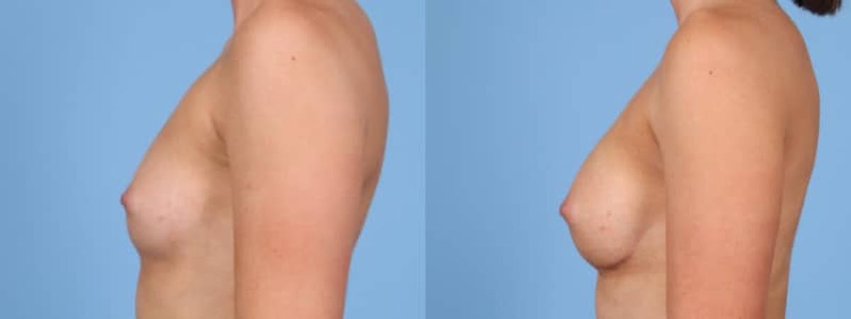 Breast Augmentation Before & After Gallery - Patient 273365 - Image 5