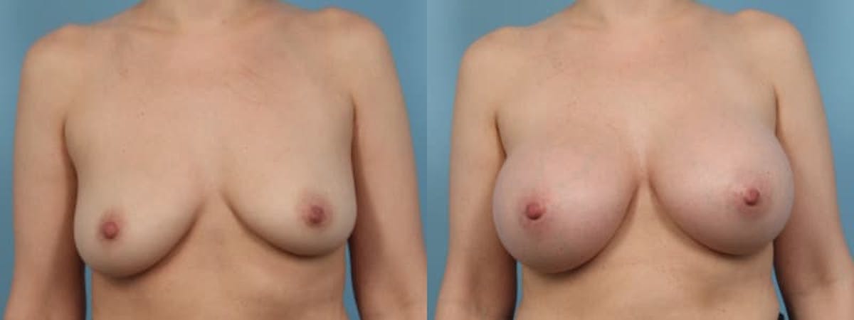 Breast Augmentation Before & After Gallery - Patient 746935 - Image 1