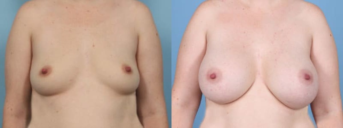 Breast Augmentation Before & After Gallery - Patient 315484 - Image 1