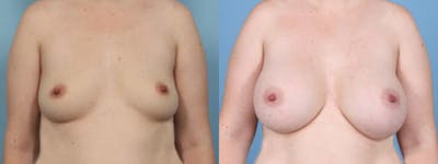Breast Augmentation Before & After Gallery - Patient 315484 - Image 1