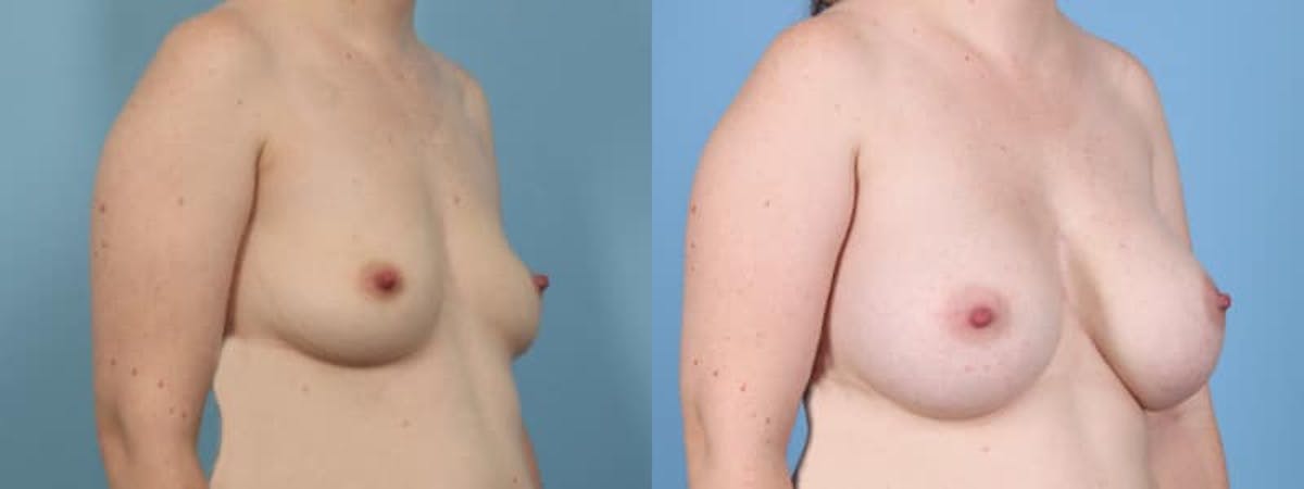 Breast Augmentation Before & After Gallery - Patient 315484 - Image 3