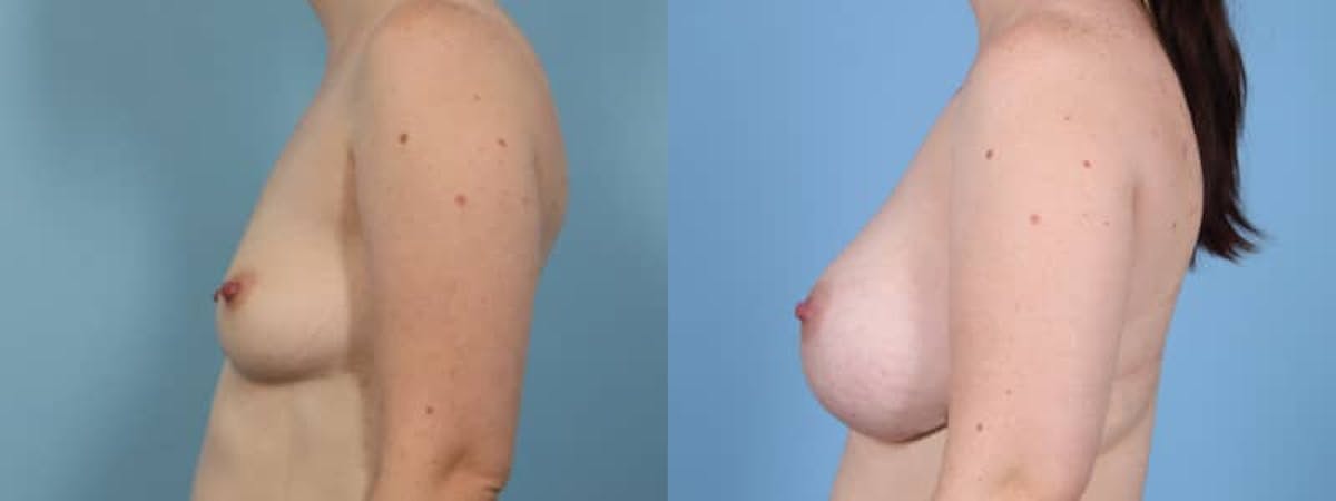 Breast Augmentation Before & After Gallery - Patient 315484 - Image 4
