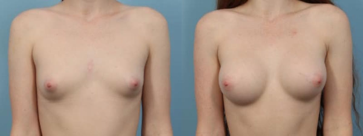 Breast Augmentation Before & After Gallery - Patient 406675 - Image 1