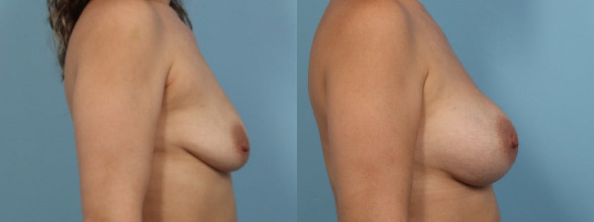 Breast Augmentation Before & After Gallery - Patient 132669 - Image 4
