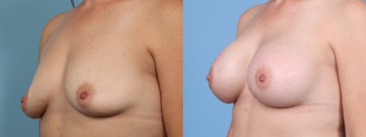 Breast Augmentation Before & After Gallery - Patient 215165 - Image 2