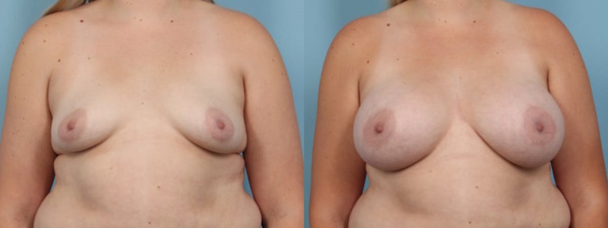 Breast Augmentation Before & After Gallery - Patient 907796 - Image 1