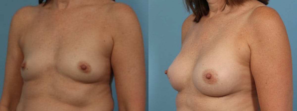 Breast Augmentation Before & After Gallery - Patient 706172 - Image 2