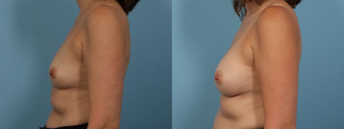 Breast Augmentation Before & After Gallery - Patient 706172 - Image 5