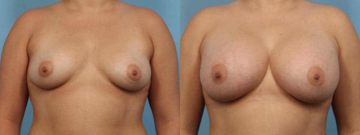 Breast Augmentation Before & After Gallery - Patient 256399 - Image 1