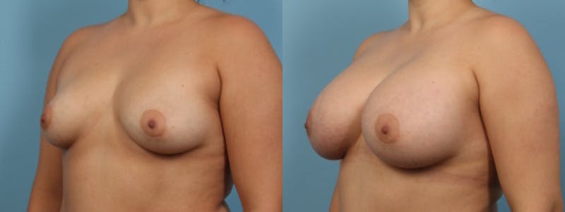 Breast Augmentation Before & After Gallery - Patient 256399 - Image 3