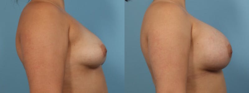 Breast Augmentation Before & After Gallery - Patient 256399 - Image 4