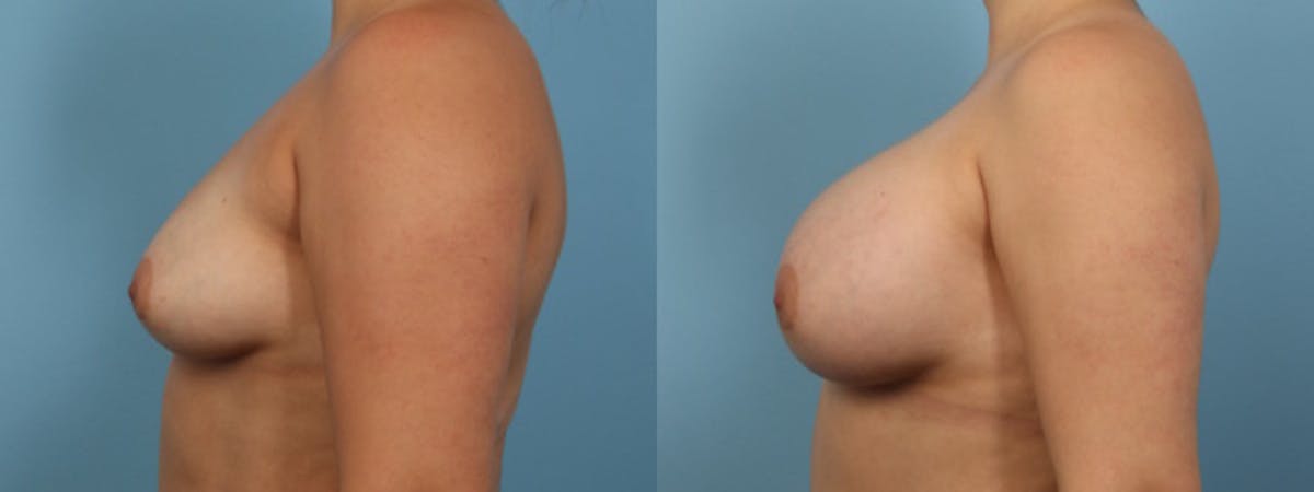 Breast Augmentation Before & After Gallery - Patient 256399 - Image 5