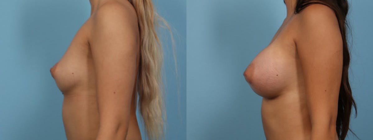 Breast Augmentation Before & After Gallery - Patient 242527 - Image 4
