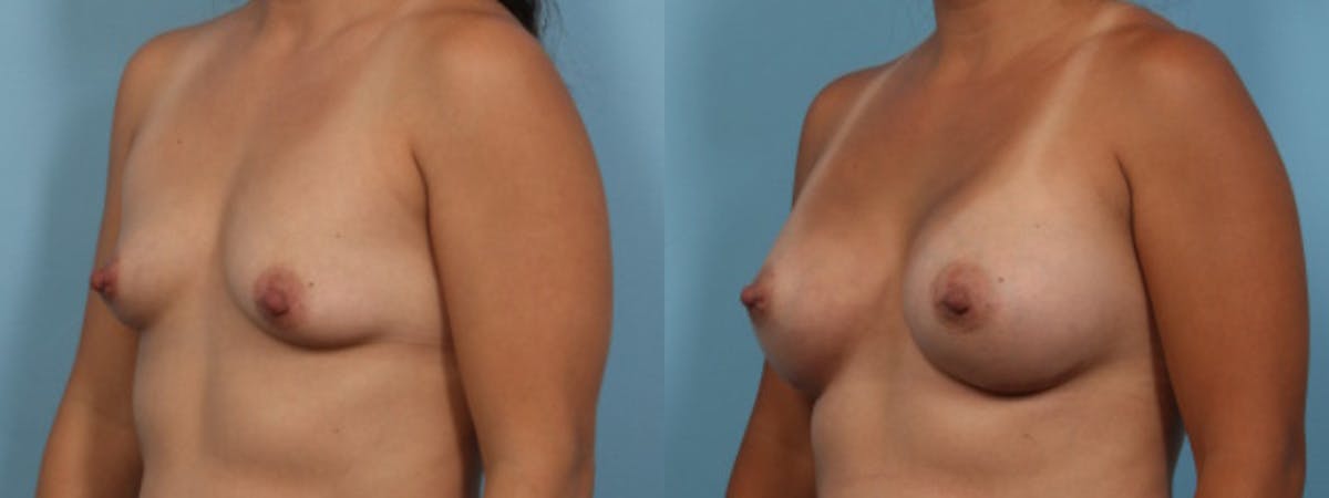 Breast Augmentation Before & After Gallery - Patient 361476 - Image 2