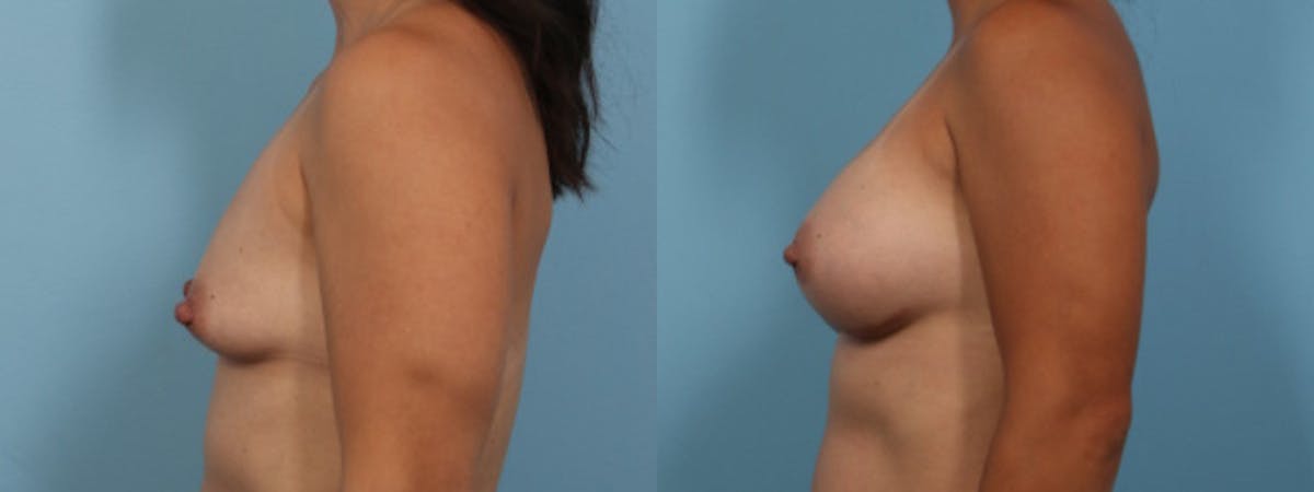 Breast Augmentation Before & After Gallery - Patient 361476 - Image 5