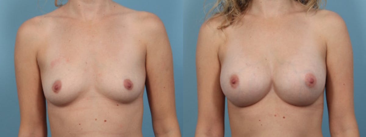 Breast Augmentation Before & After Gallery - Patient 156907 - Image 1