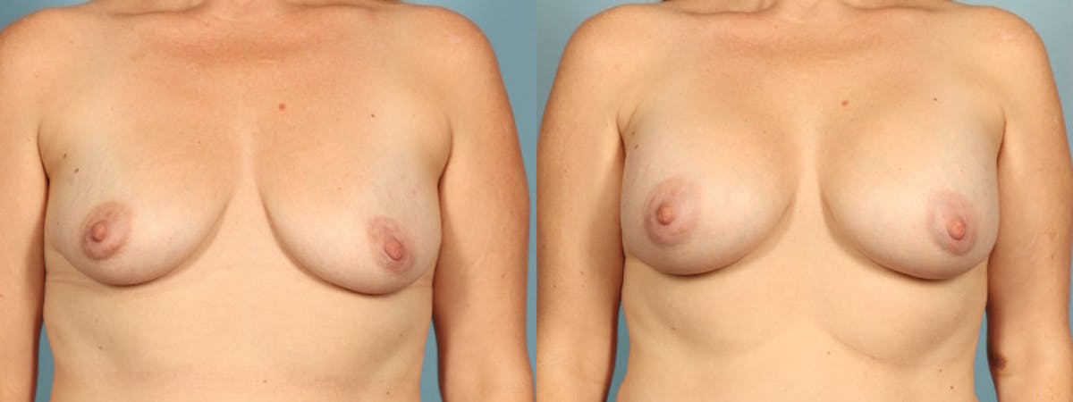 Breast Augmentation Before & After Gallery - Patient 421284 - Image 1