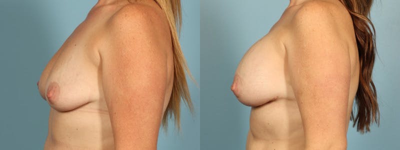 Breast Augmentation Before & After Gallery - Patient 421284 - Image 4