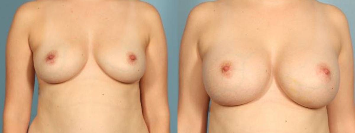 Breast Augmentation Before & After Gallery - Patient 361255 - Image 1